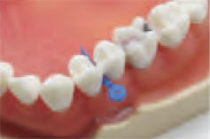 Введение клина COTISEN